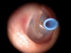 ATT type T tube