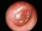 Otite phlyctenulaire