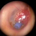 Polype inflammatoire sur T tube