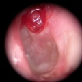 Polype inflammatoire de la region atticale