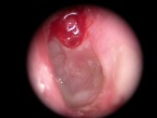 Polype inflammatoire de la region atticale