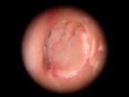 toto cartilage