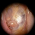 Perforation et cholesteatome