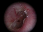 Perforation  Barotraumatisme en plongée