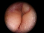 Exostose