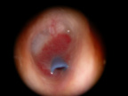Otorrhée avec polype inflammatoire sur T tube