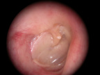 Totocartilage 9 mois après intervention 
