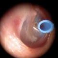 ATT type T tube