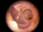 Otite chronique non cholesteatomateuse