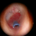 Otorrhée avec polype inflammatoire sur T tube